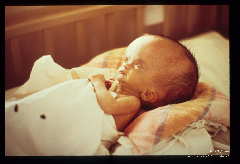 Congenital toxoplasmocis with chorioretinitis and hydrocephaly.