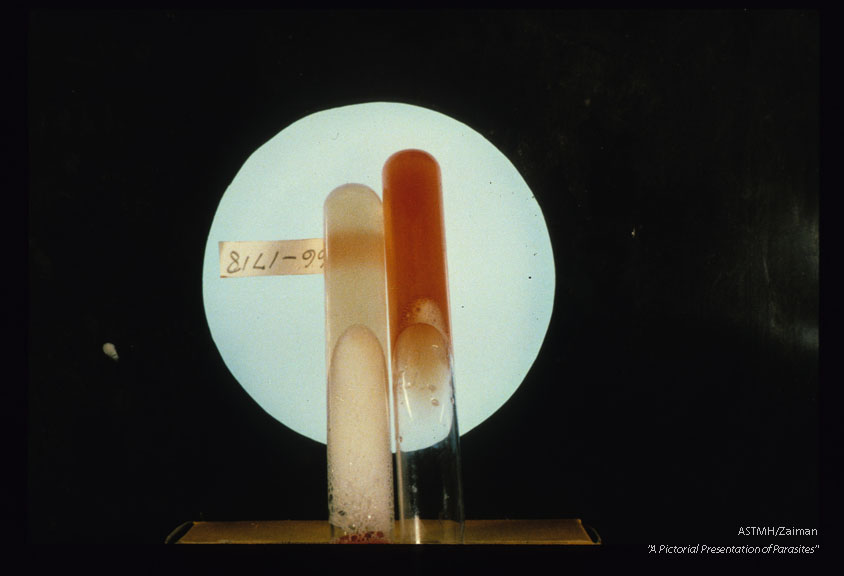 Cyst fluid with and without contaminating blood.