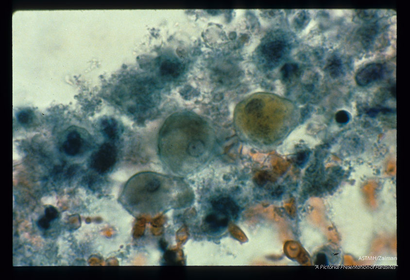 Multiple Pap smear fields from the cervix of the same patient. Various magnifications.