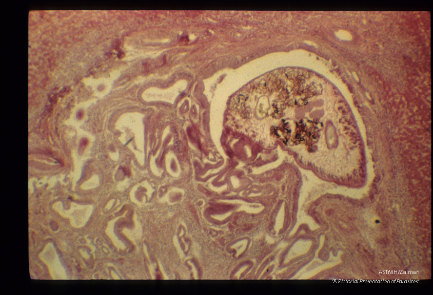 Adult in bile duct which shows marked hyperplasia of epithelium.