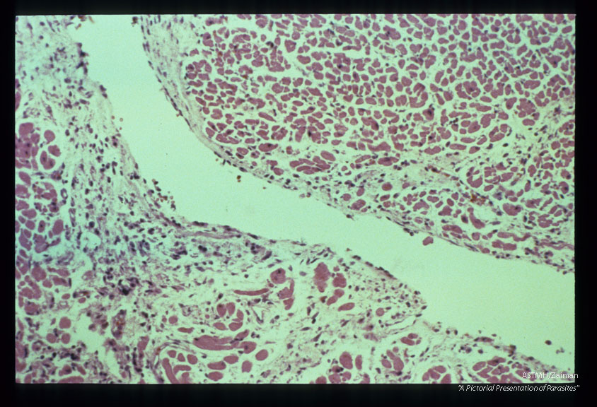 Endomyocarditis. Lymphoplasmocytic infiltrate.