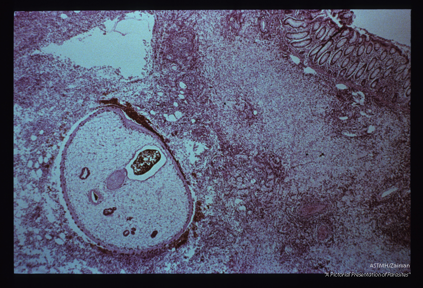 Adult embedded in intestinal wall. The parasite presents as an oval to round mass limited by a spined cuticle. The parasitic parenchyme is punctuated by multiple sections through gut (reddish-brown). The two centrally located tubular structures, separated by a light staining muscular sucker, are part of the reproductive apparatus of the parasite. A marked inflammatory response is present in the adjacent host tissues and fresh red blood cells can be seen near the parasite.