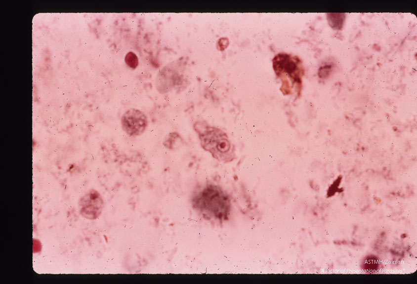 Trophozoite in stool.