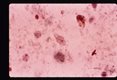 Trophozoite in stool.