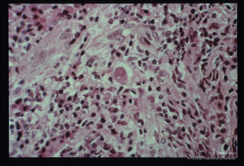 Microscopic views of amebae in skin lesion.