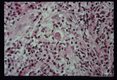 Microscopic views of amebae in skin lesion.