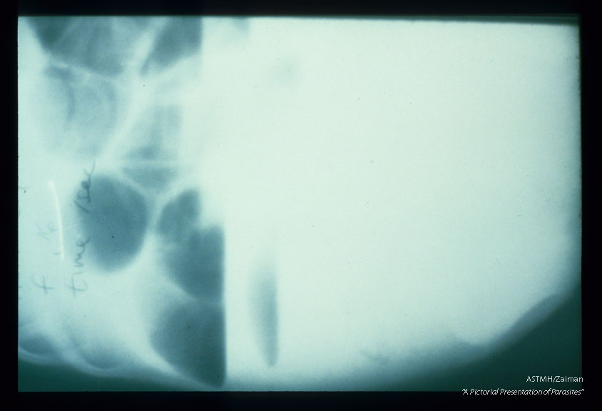 Intestinal obstruction due to ascariasis is demonstrated on x-ray by dilatation of the small bowel by gas and fluid. X-rays made in a supine patient (2116) show enlarged gas-filled (black) boweled loops. When films are made with patients in the upright position, gas (black) in the dilated loops, layers above the white fluid (2117). Dilated small bowel with air fluid levels are pathognomonic for small bowel obstruction. In this case, the obstruction was due to A scans.