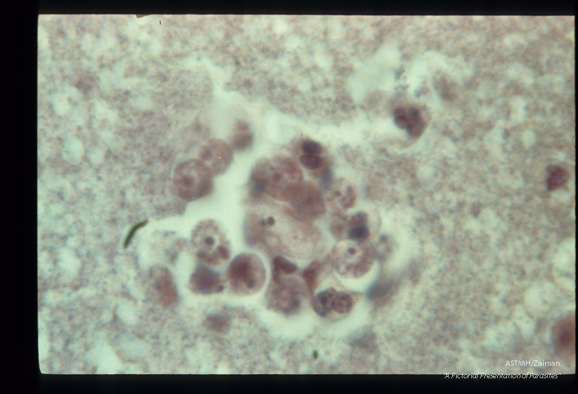 Brain with trophozoites, H & E.