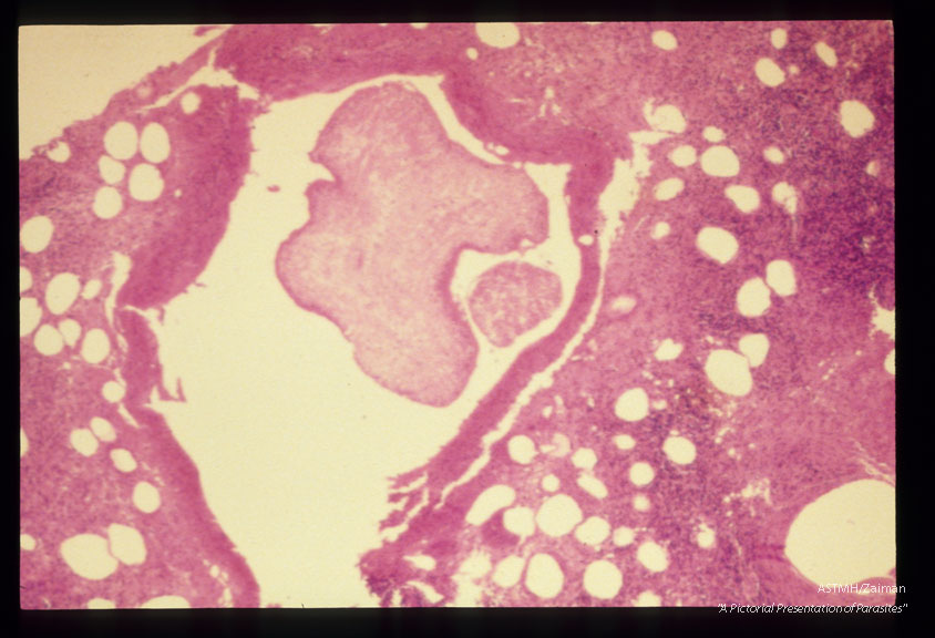 Low power view of sparganum in subcutaneous tissue of human abdominal wall.