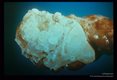 Cyst in kidney.