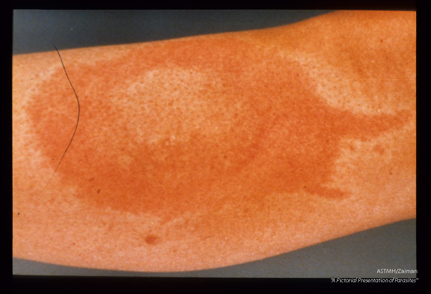 Rash. The rash usually begins as a red macula at the inoculation site. It expands forming a large annular red bordered lesion with central clearing and induration.