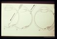 Diagramatic depiction of removal of daughter buds which dropped off in vitreous plus transcleral freezing of buds left within plana of retina.