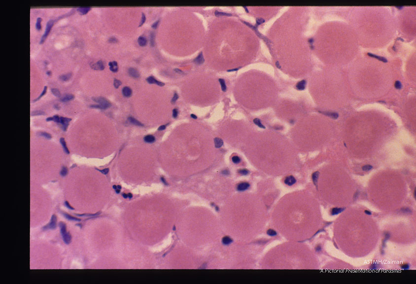 These slides are from a second such case. Reference Amer. Journ. Surg. Path. '11(8): 598-605,1987.