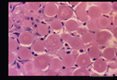 These slides are from a second such case. Reference Amer. Journ. Surg. Path. '11(8): 598-605,1987.