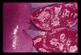 Same patient. Cut surface of liver showed marked periportal fibrosis. the intervening parenchyma being fairly normal. Many cases with severe disease show less portal fibrosis. The enlarged spleen weighed 700 grams.