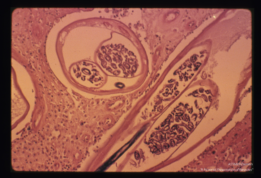 At higher power, the microfilariae are readily identified. The gut is seen as a cross section in the lower parasite and longitudinally in the upper parasite.