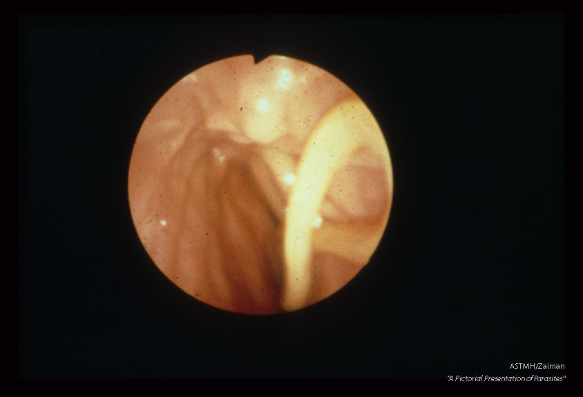 Adult worm seen in biliary tract at endoscopy.