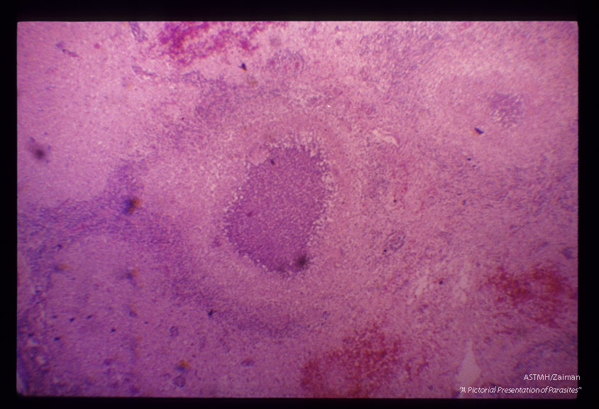 Egg in spinal cord.