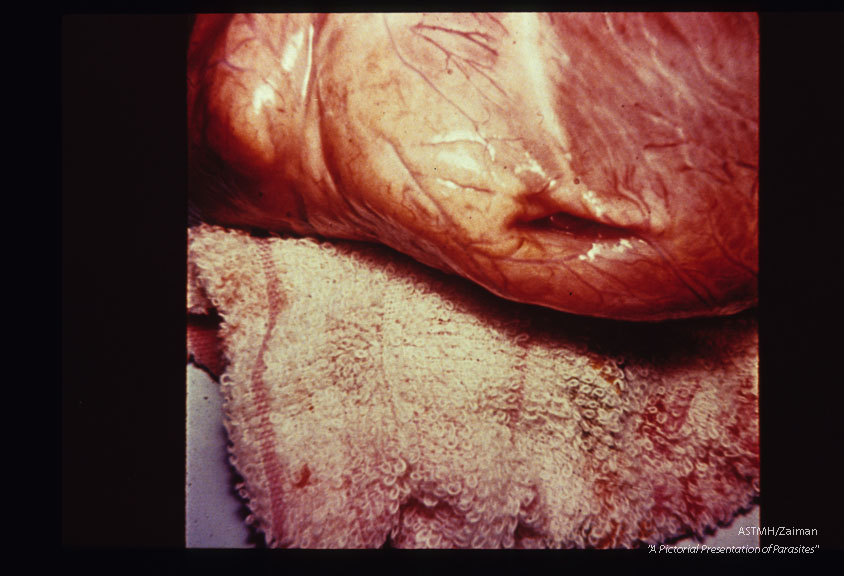 Multiple specimens showing aneurysmal dilatation and thinning of the apical myocardium, plus marked concentric muscular hypertrophy.