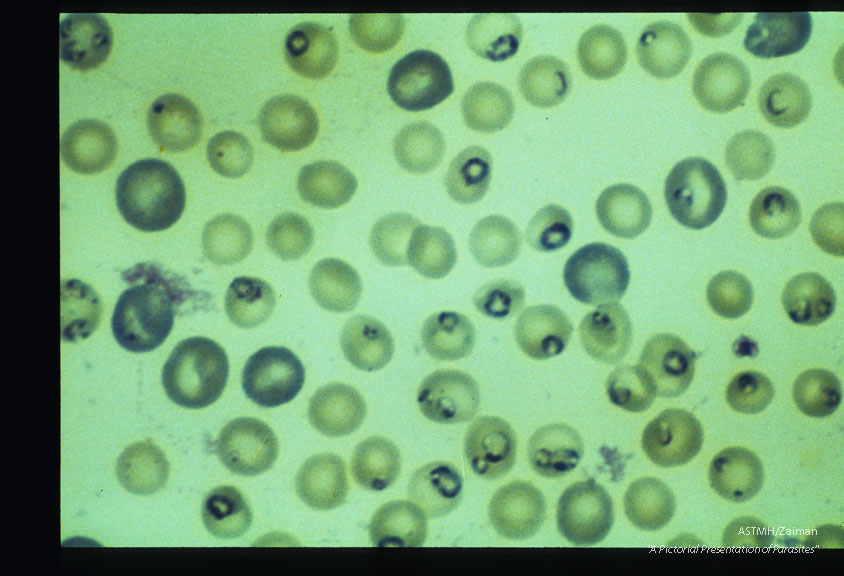 Giemsa stained slides from a fatal case on Fire Island, N. Y., (1982). The parasitemia is high for human babesiosis. Budding, multiply-infected erythrocytes, tetrad formation, band forms, reticulocytosis and clumping of extracellular parasites may be seen.