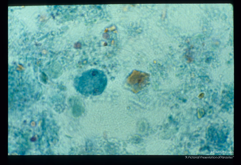 Trophozoite in stool. Trichrome stain.