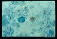 Trophozoite in stool. Trichrome stain.
