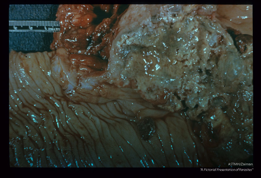 Adults woven into mucosa of 22 yr. old Chinese female. Ulcerating carcinoma seen in lower power photographs.