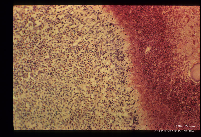 Traumatic hepatitis caused by migration of immature larvae. Junction of necrotic liver tissue and zone of cell reactions shown.