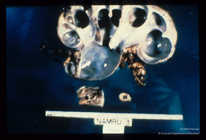 Hydroureter and hydronephrosis, fresh and formalin fixed specimens.