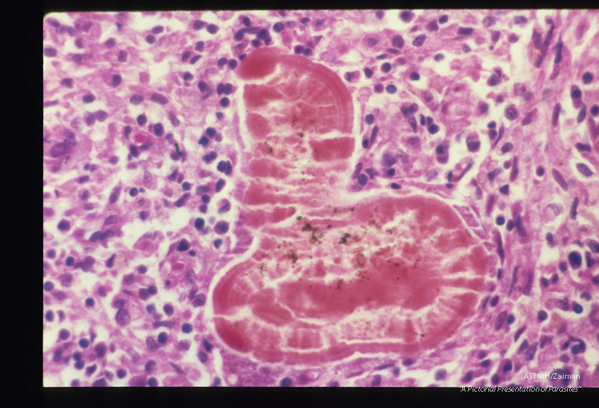 Leisegang rings have been mistaken for eggs of the giant kidney worm Dioctophvma renale by multiple authors. They are periodic precipitation zones formed from supersaturated solutions in colloidal systems. These slides are from one such case.