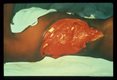 The huge red lesion is a cutaneous ulcer due to amoebiasis of the skin of the right body wall. The white garment covers the lady's breast.