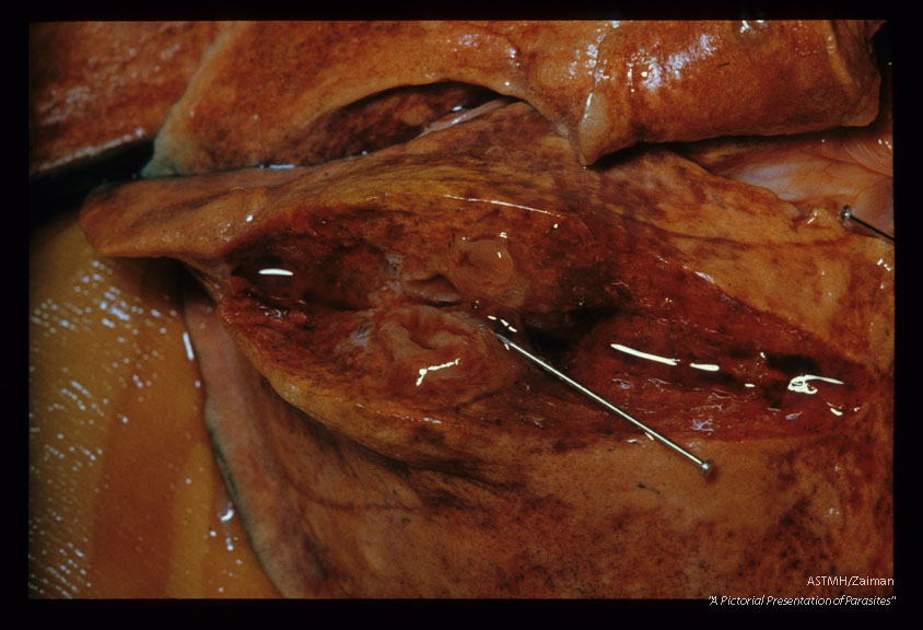 Cat lung showing an open cyst (pin point) from which the worm has left