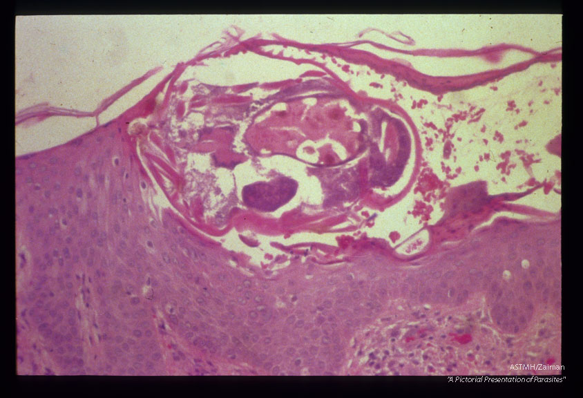 Mite in skin.