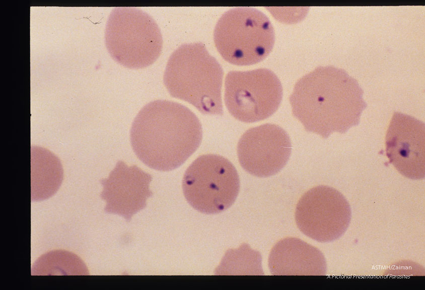 Giemsa stained slides from a fatal case on Fire Island, N. Y., (1982). The parasitemia is high for human babesiosis. Budding, multiply-infected erythrocytes, tetrad formation, band forms, reticulocytosis and clumping of extracellular parasites may be seen.