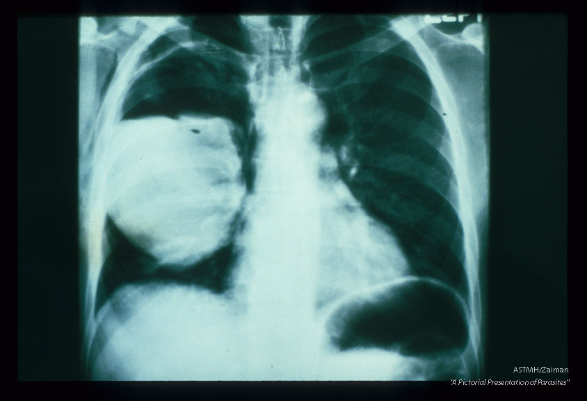 Frontal and lateral chest x-rays. A huge partially empty white cyst is present in the right lung of this patient. It's upper limits are marked by a white pencil-like line of calcium, Above the white fluid and below the white penciled line, the cyst is filled with air (black). This indicates communication between the cyst and a bronchus. Usually an air-fluid interface would be a neat line. In echinococcosis, the line is irregular due to floating collapsed membranes (from the dome of the cyst) and floating daughter cysts. This is the classic floating lily sign of pulmonary echinococcosis.