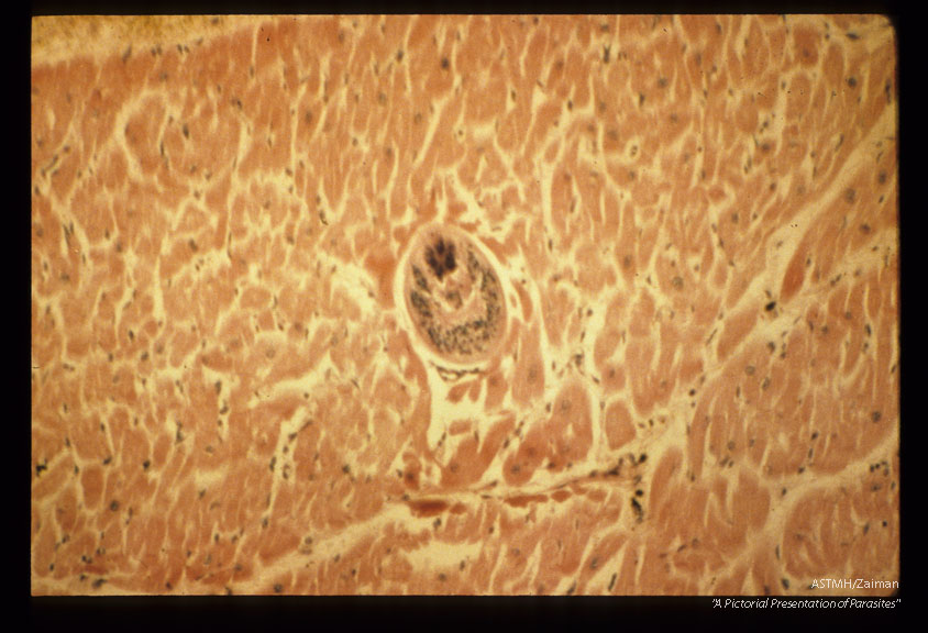 Heart showing hemorrhage and mesocercaria.