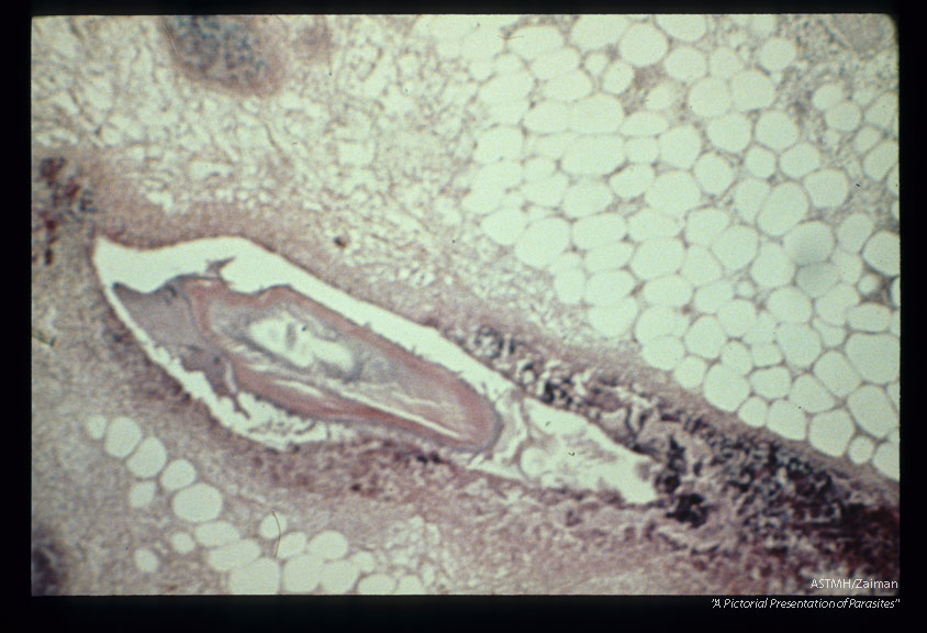 Multiple sections through anisakid nematodes and inflammatory infiltrate they induced in a human cecum.