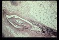 Multiple sections through anisakid nematodes and inflammatory infiltrate they induced in a human cecum.