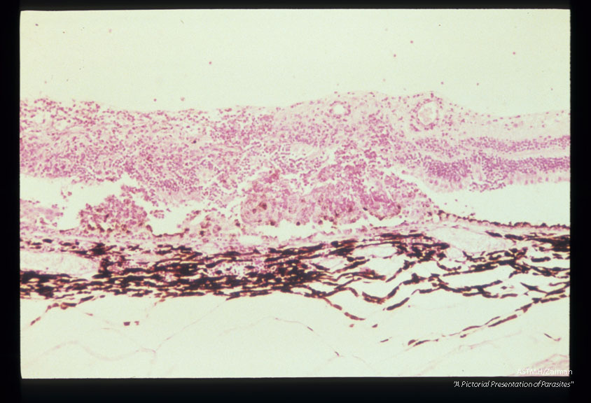 Retinal disruption, necrosis, and eosinophilic retinitis in an experimentally infected cynomolgus monkey.