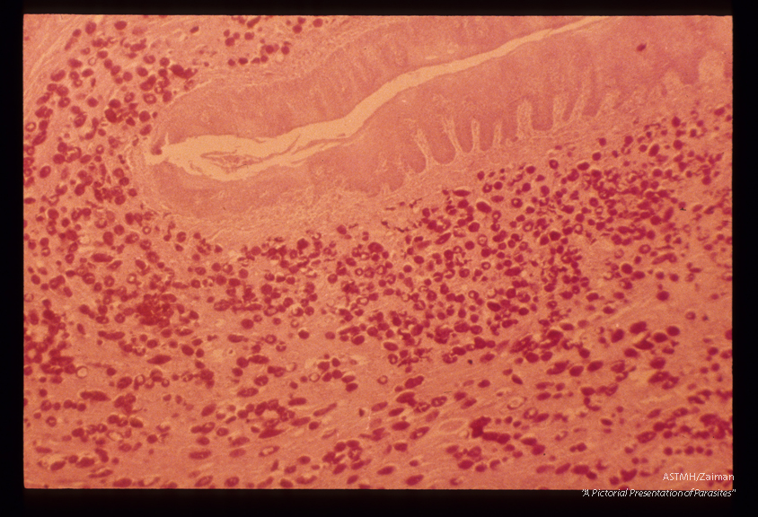 Eggs in human urinary bladder. The open space at the upper portion of the slide is the bladder lumen. The normal urinary bladder epithelium has been replaced by squamous cells.