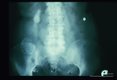 A smaller calcified cyst is present at the brim of the right pelvis. It is in a Riedel's lobe of the liver. This cyst is readily accessible to the surgeon and would be easy to remove. The dense white, pear-like structure, is the gallbladder.