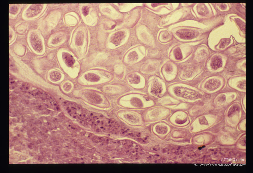 Ovarian enterobiasis.