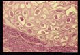 Ovarian enterobiasis.