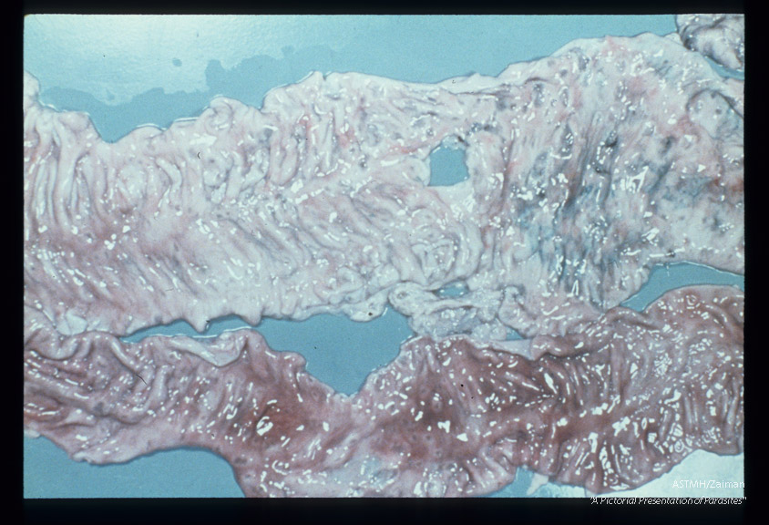 Gross pathology; ulcerative amoebic colitis.