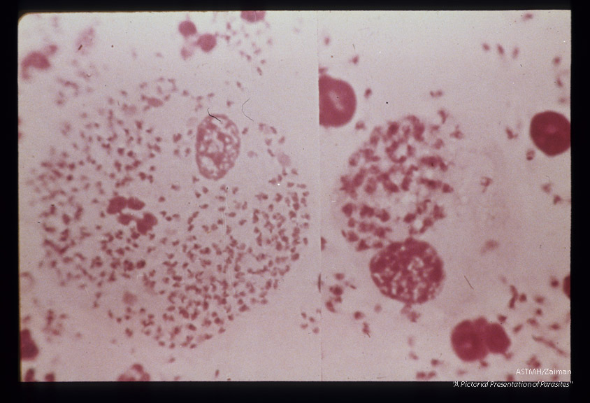 (South America). Smear from pseudo-lepromatous nodule showing Leishmania.