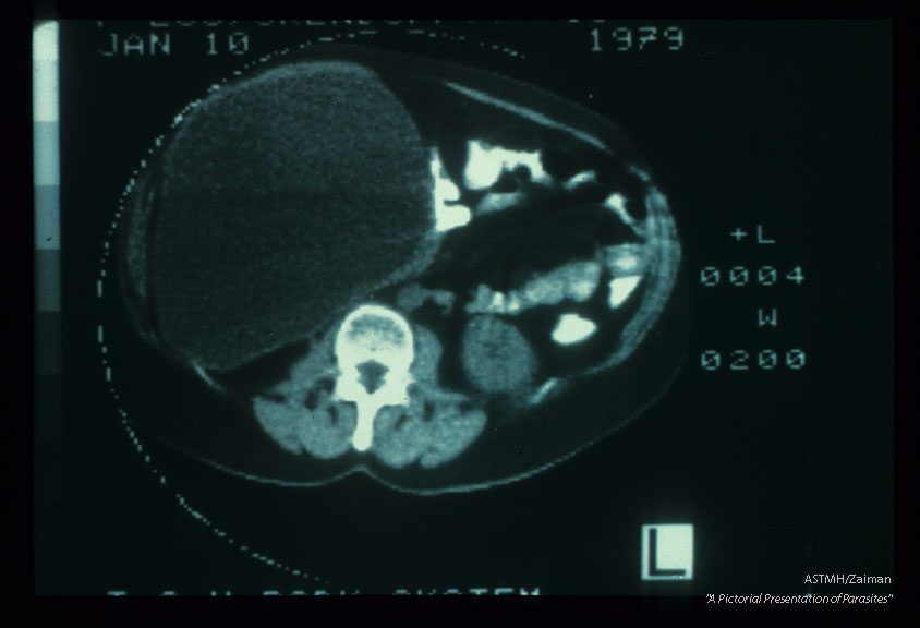 Intraperitoneal cyst. CT scan (1529) and surgical specimen.