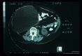 Intraperitoneal cyst. CT scan (1529) and surgical specimen.