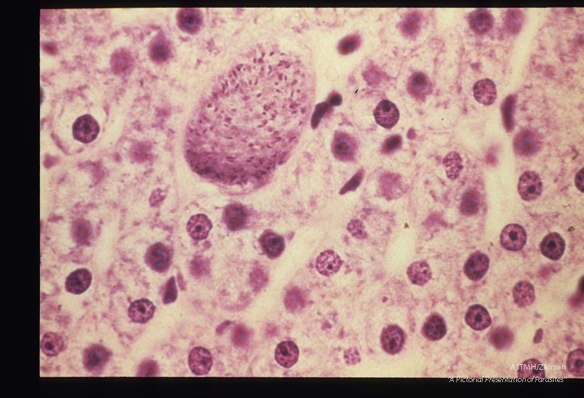 Demonstration of hypnozoiite and hepatic schizonts by immunof lucres cent antibodies and subsequent counterstaining by Giemaa-colophonium.