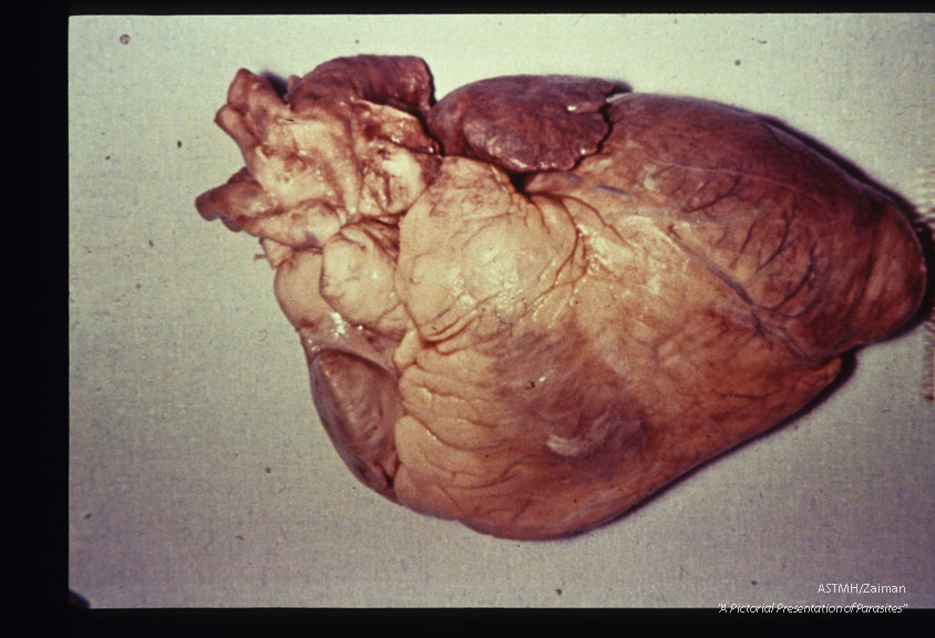 Multiple specimens showing aneurysmal dilatation and thinning of the apical myocardium, plus marked concentric muscular hypertrophy.