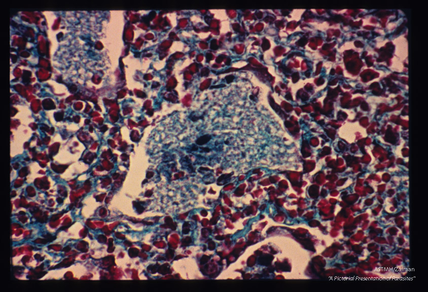 Pneumonia. Higher magnification of infected lung stained by Wheatly modification of trichrome stain for stools showing "honeycomb" ma­terial in alveoli. Parasites are also seen and oc­casionally nuclear material is visible within the parasites.